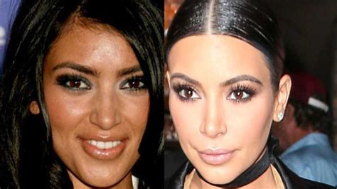 Kim Kardashians Plastic Surgery Timeline Before And After Surgery