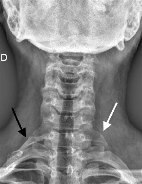 Anteroposterior Cervical X Ray Of The First Case Showing The Cervical