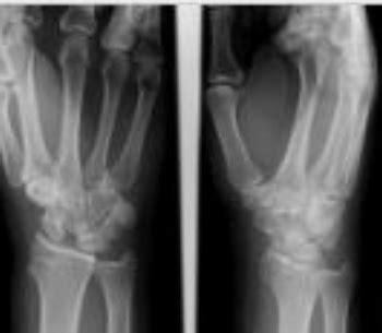 A Y O Male Complains Of Persistent Pain In The Wrist After A Fall Wash U Em Blog