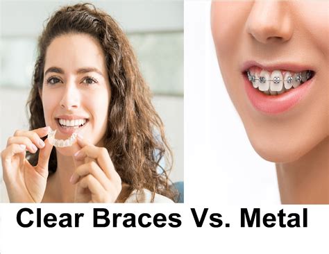 Clear Braces Vs Metal Which One Is Better