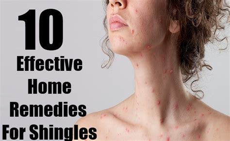 10 Home Remedies For Shingles Morelia Medical Clinic