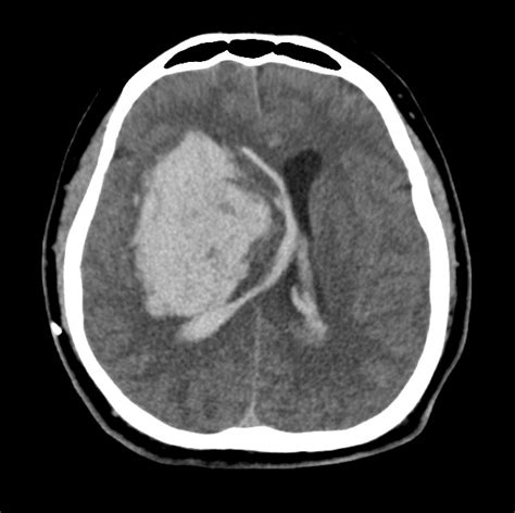 What are the findings from the ct scan report? Massive basal ganglia hemorrhage (BGH) in computed ...