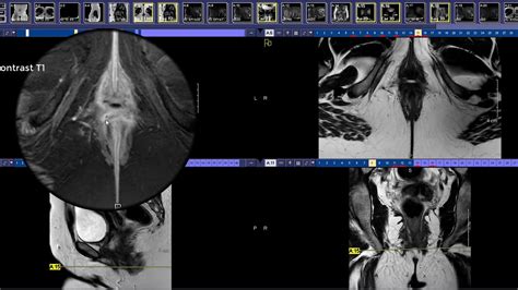 How To Read An Anal Fistula Mri Youtube