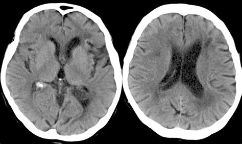 Comprehensive Imaging Of Ischemic Stroke With Multisection CT