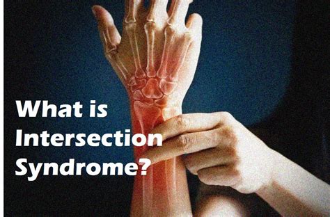 What Is Intersection Syndrome Regenexx