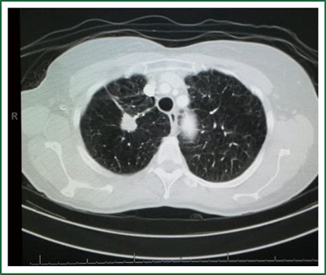 White Spots On Ct Scan Of Lungs Ct Scan Machine Images And Photos Finder