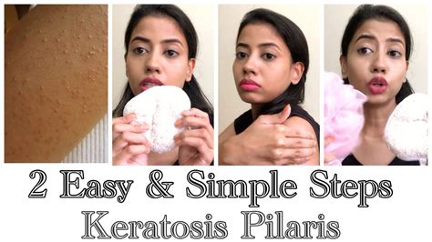 How To Get Rid Of Chicken Skin With Natural Remedykeratosis Pilaris