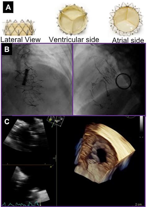 Frontiers Transcatheter Tricuspid Valve Replacement Principles And