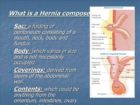 Ppt Hernias Powerpoint Presentation Free Download Id236632