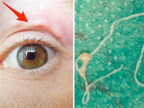 A Moving Lump On A Woman S Face Was A Worm Crawling Under Her Skin Business Insider