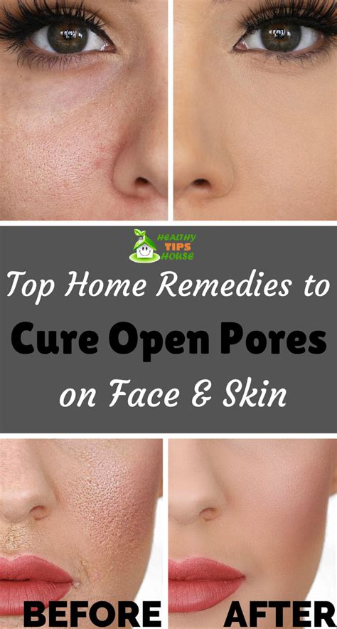 Use These Natural Remedies To Put An End To Open Pores Open Pores On