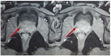 Contrast Enhanced Ct Scan Showing A Heterogeneously Enhanced Mass