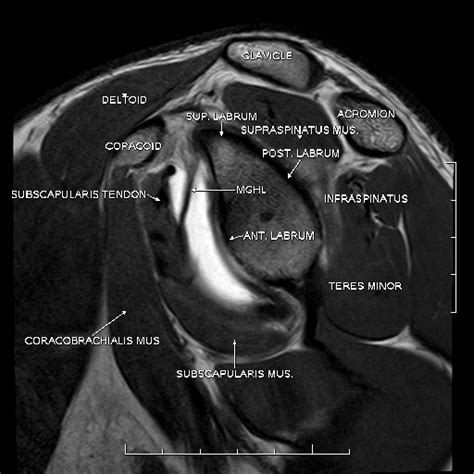 Radiology Anatomy Images Sagittal Anatomy Of Shoulder Mri