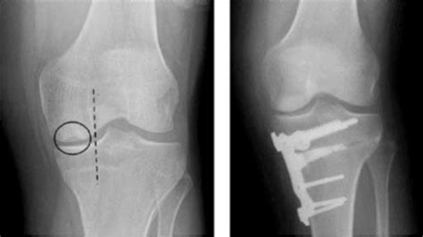 High Tibial Osteotomy X Ray