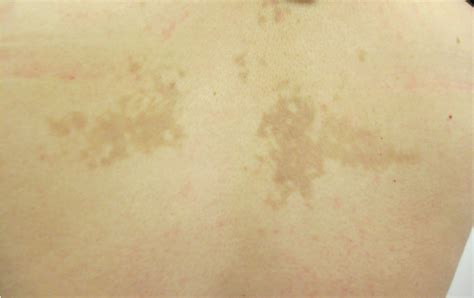 Skin Lesions Erupt Across A Teenagers Upper Back Consultant360