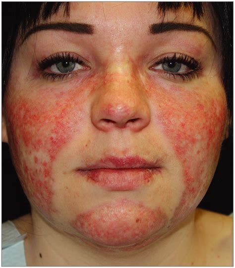 Lupus What Causes The Lupus Butterfly Rash Redorbit Find Out