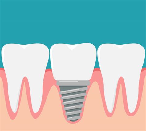 Royalty Free Dental Implant Clip Art Vector Images And Illustrations