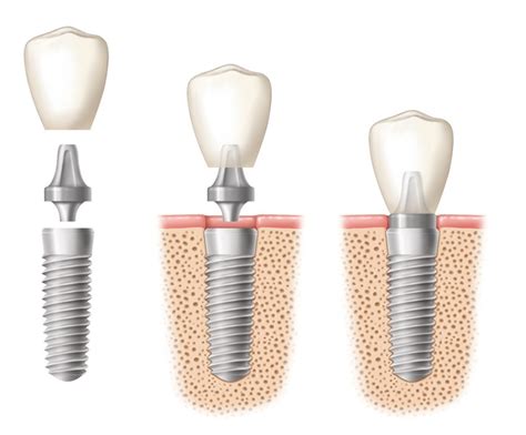 7 Reasons Why Dental Implants Are The Gold Standard Of