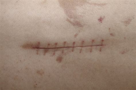 How To Treat Scars After Surgery Livestrongcom