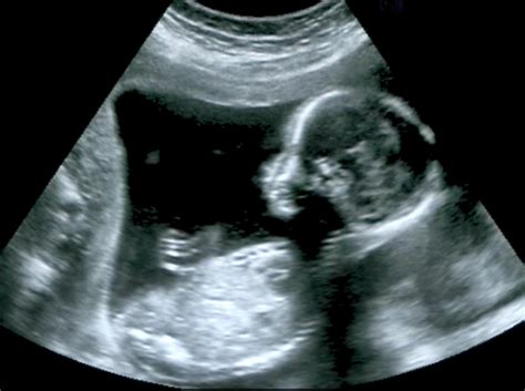 Measurements at the scans for determining paternity because the earliest point during the. Second trimester dating scan. week pregnancy dating scan - NHS