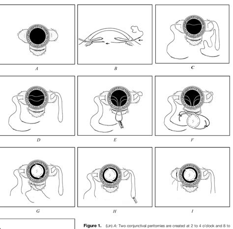 Figure 1 From Suture Fixation Technique For Posterior Chamber Intraocular Lenses Semantic Scholar