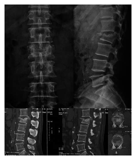 X Ray And Ct Scan Showing A Burst Fracture On L2 Vertebra With A