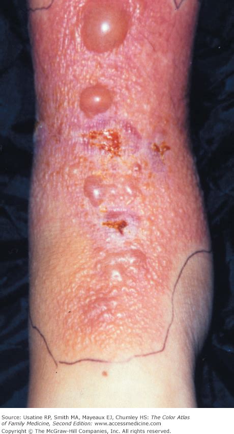 In this article, learn about the causes and symptoms. Contact Dermatitis | Basicmedical Key