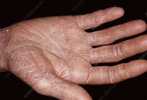 Contact Dermatitis Stock Image C0509948 Science Photo Library