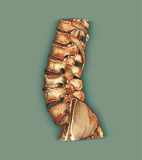 Arthritis Of The Spine Photograph By Zephyrscience Photo Library