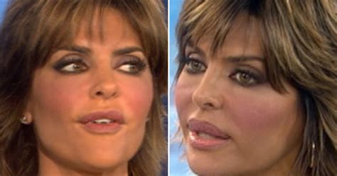 Lisa Rinna Reduces Famously Large Lips