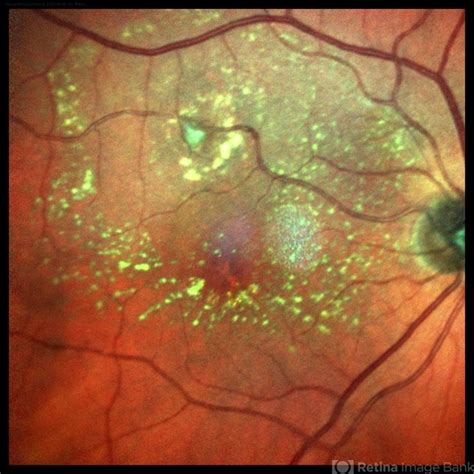 Retinal Arterial Macroaneurysm Retina Image Bank