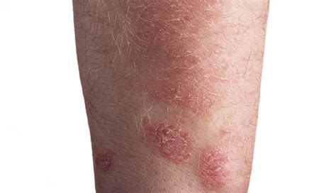 Biologics May Up Fungal Infection Risk In Patients With Psoriasis The