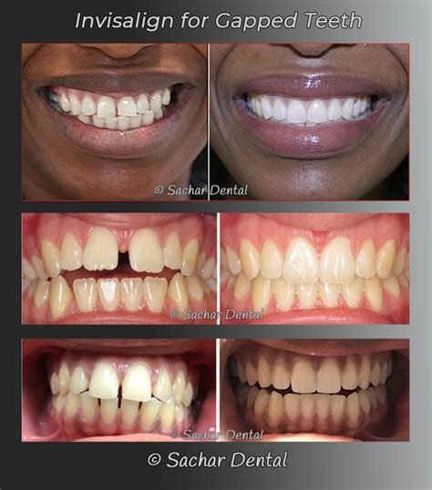 How To Close Gap In Teeth With Braces How Long Do You Think It Will