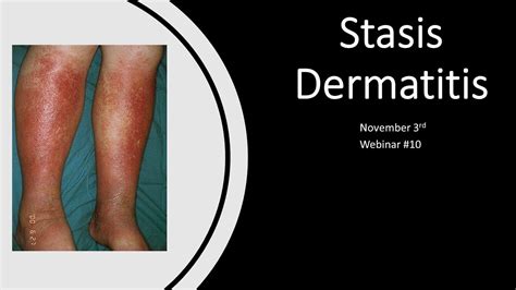 Exosomes Webinar 10 Stasis Dermatitis Youtube