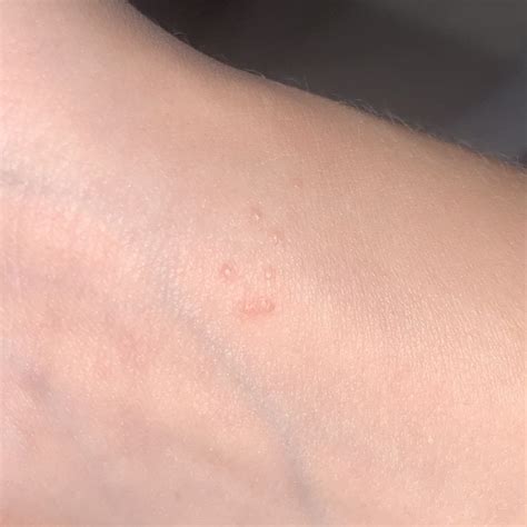 Small Bumps On Hands Dermatologyquestions
