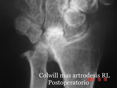 OSSA CARPALIA La articulación radio cubital distal en la artritis