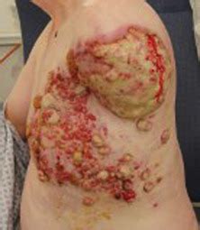 Reconstruction after surgery for skin cancer. Electrochemotherapy for treatment of Merkel cell carcinoma ...