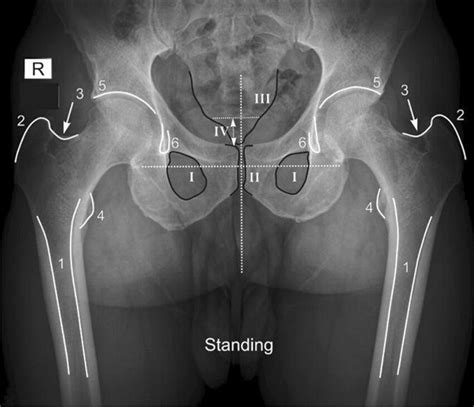 standing anteroposterior pelvic radiograph 1 femoral shaft 2 download scientific diagram