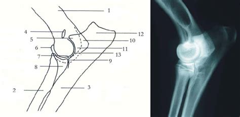 Schematic Drawing And Radiographic Anatomy Of The Elbow Lateral