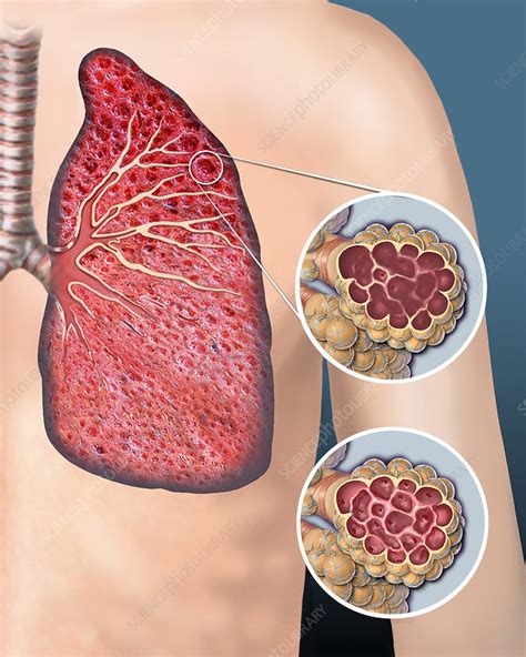 Chronic Obstructive Pulmonary Disease Illustration Stock Image