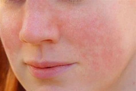 Discoid Lupus Rash On Face
