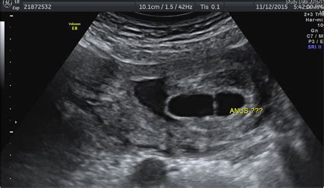 Prenatal Diagnosis Of Congenital Megalourethra With Imperforate Anus