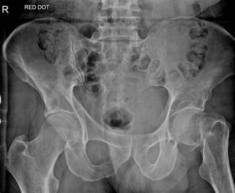 Hip Radiographs Quiz