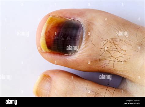 Nail Bed Hi Res Stock Photography And Images Alamy
