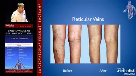 Diagnosis And Management Of Varicose Veins Mitul Patel Md Youtube