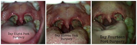 Tonsillectomy Warning Photos