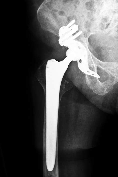 Pain After Hip Replacement Might Be Osteolysis Hip Lawyer