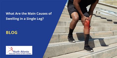 What Are The Main Causes Of Swelling In A Single Leg