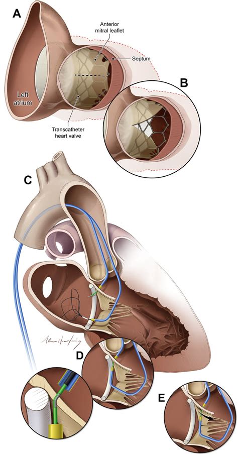 Views Of The Anterior Mitral Valve Leaflet From The Lvot Download