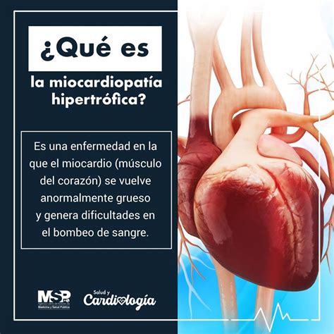 Cuales Son Los Sintomas De La Miocardiopatia Hipertrofica Sexiz Pix